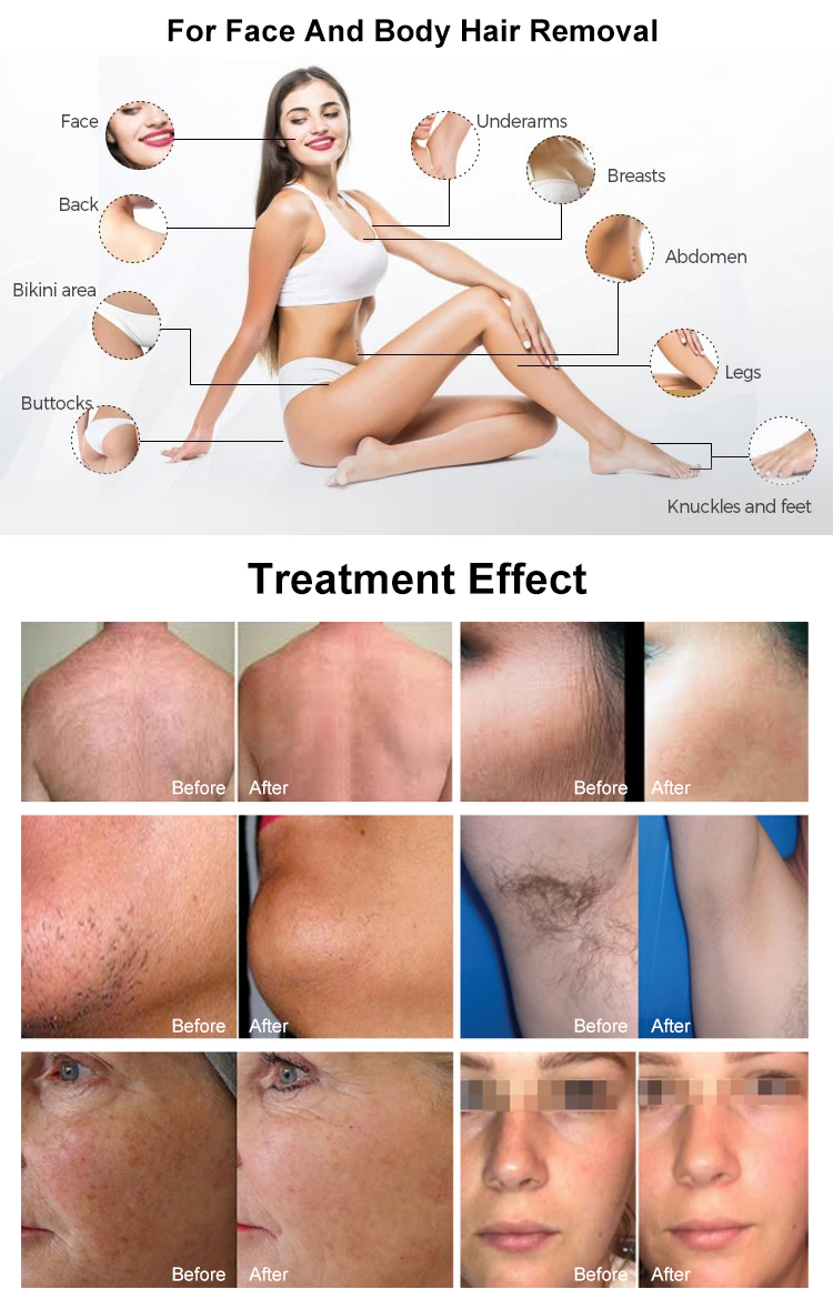 808nm diode laser epilation machine08